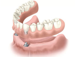 Implantes y Prótesis
