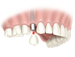 Implantes y Prótesis